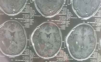Gliomas of Brain