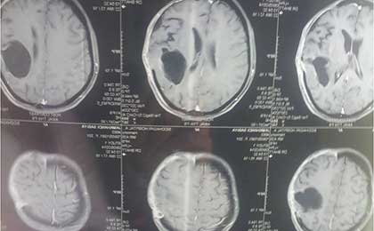 Gliomas of Brain
