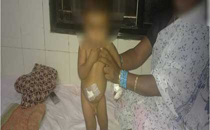 Hydrocephalus