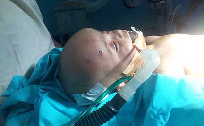 Hydrocephalus