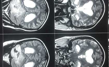 Hydrocephalus