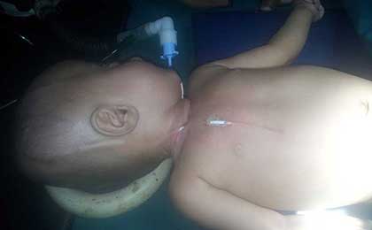 Hydrocephalus
