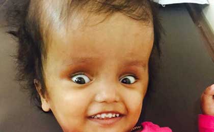 Hydrocephalus