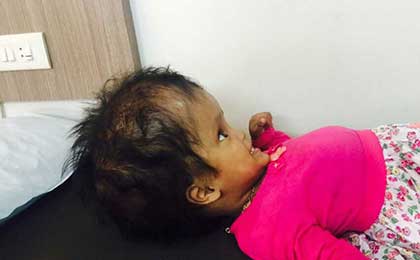 Hydrocephalus