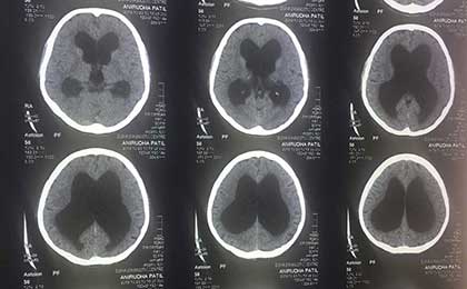 Hydrocephalus