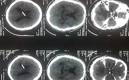 Hydrocephalus