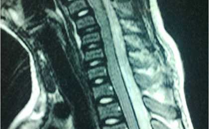 Infection in Spine