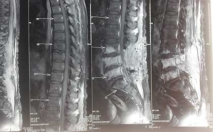 Infection in Spine