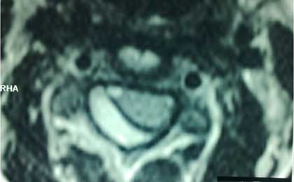 Infection in Spine