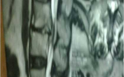 Infection in Spine