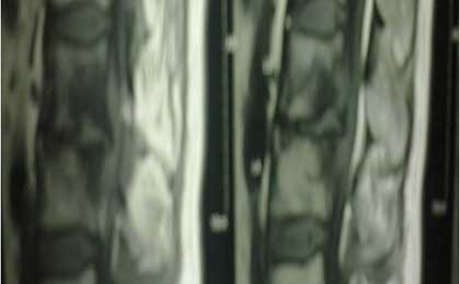 Infection in Spine