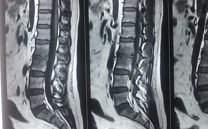 Infection in Spine
