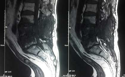 Infection in Spine