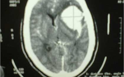 Intracerebral Haematoma