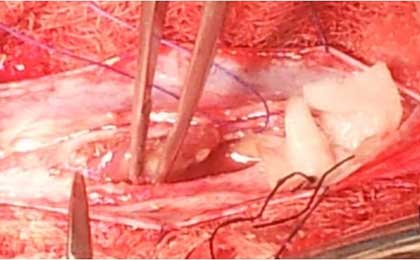 Intramedullary Tumor of Spine