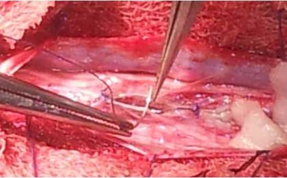 Intramedullary Tumor of Spine