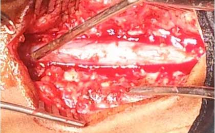 Intramedullary Tumor of Spine