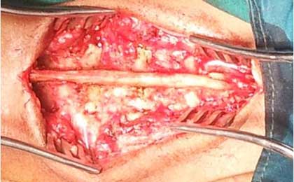 Intramedullary Tumor of Spine