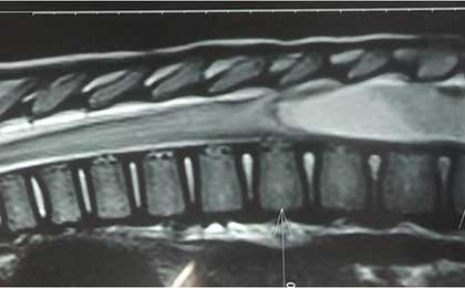 Intramedullary Tumor of Spine