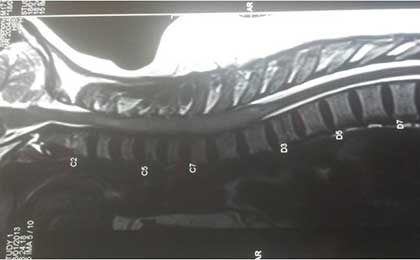 Intramedullary Tumor of Spine