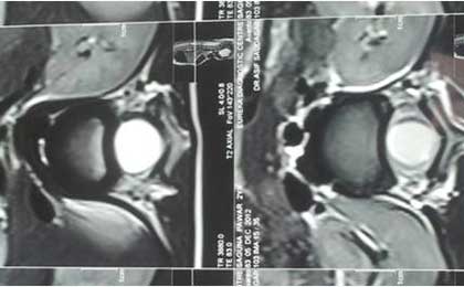 Intramedullary Tumor of Spine
