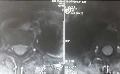 Intramedullary Tumor of Spine