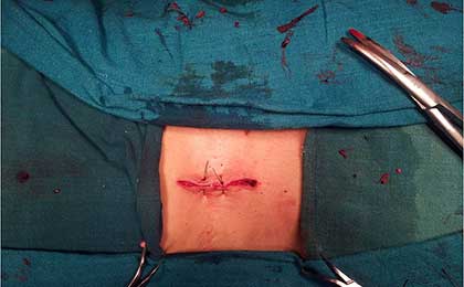 Lumbar Disc