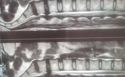 Lumbar Disc