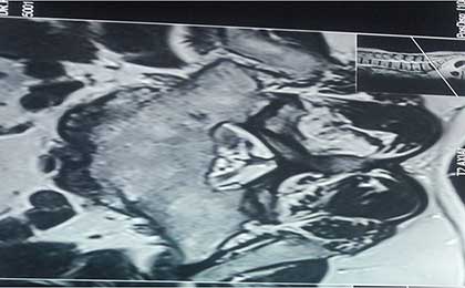 Lumbar Disc