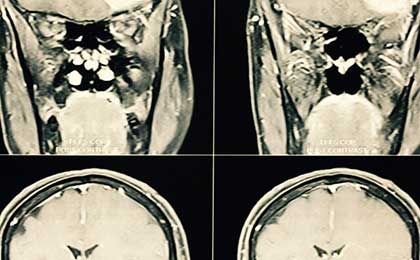 Meningioma of Brain