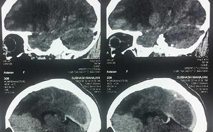 Meningioma of Brain