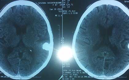 Meningioma of Brain