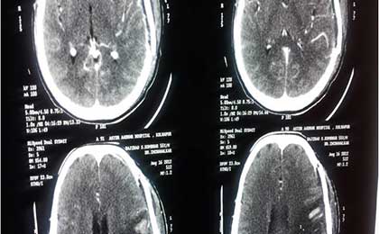 Meningioma of Brain