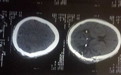 Meningioma of Brain