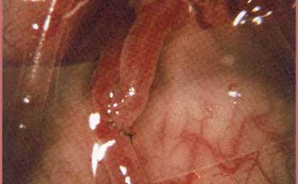 Meningioma of Brain