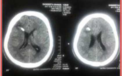 Meningioma of Brain