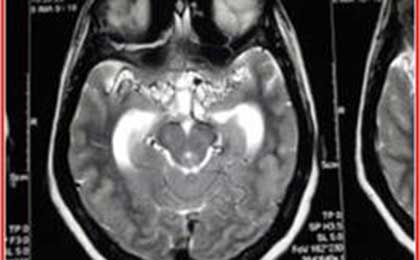 Meningioma of Brain