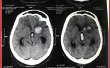 Meningioma of Brain