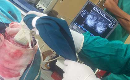 Meningioma of Brain