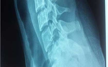 Osteoid Osteoma Paraspinal