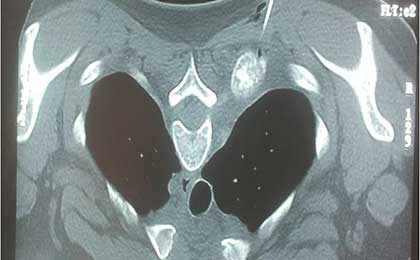 Osteoid Osteoma Paraspinal