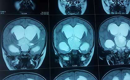 Paediatric Brain Tumors