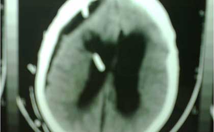Paediatric Brain Tumors