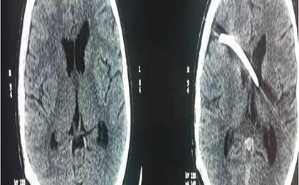 Paediatric Brain Tumors