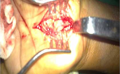 Peripheral Nerve Tumor