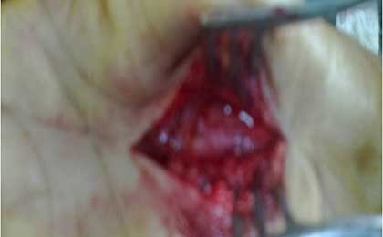 Peripheral Nerve Tumor