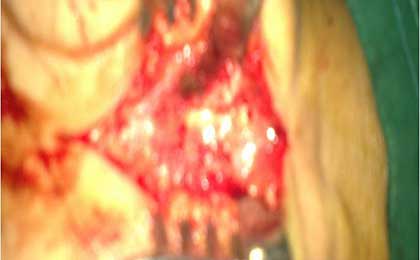 Peripheral Nerve Tumor