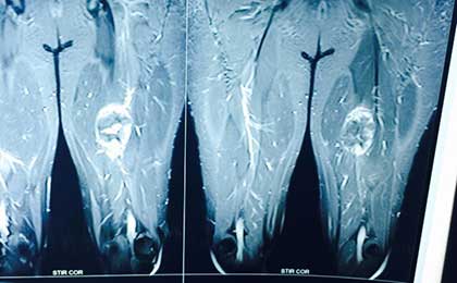 Peripheral Nerve Tumor