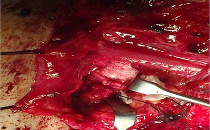 Peripheral Nerve Tumor