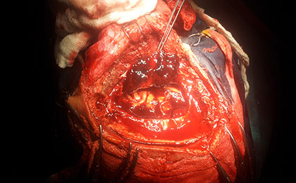 Subdural Haematoma